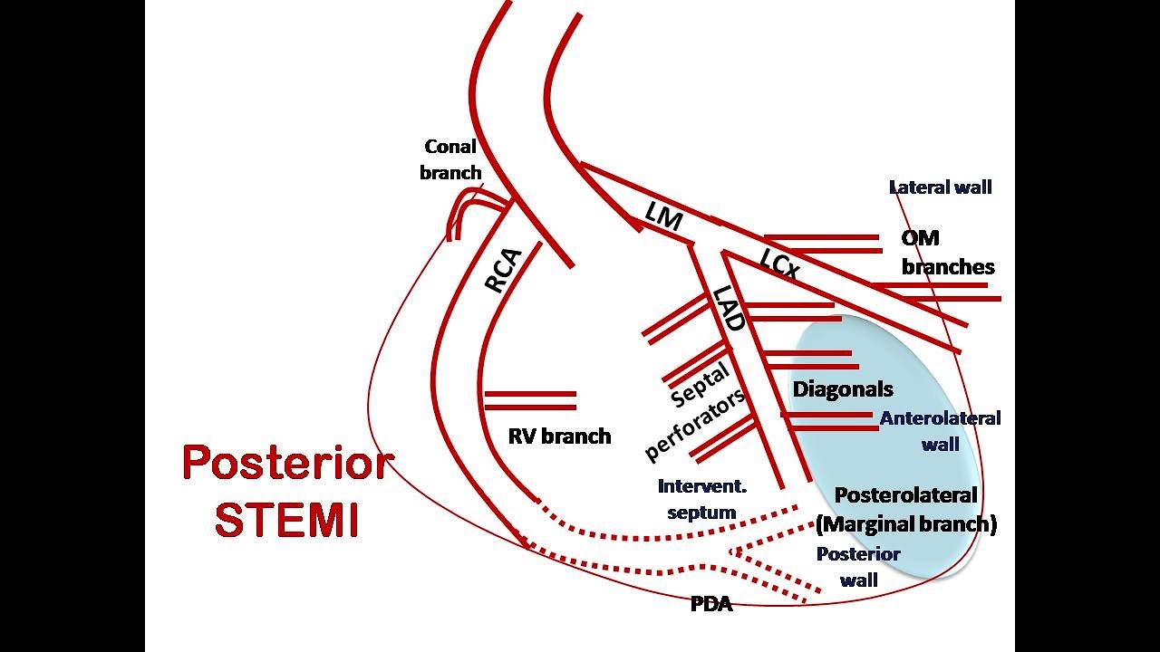 ECG course: Culprit in Posterior STEMI, Dr. Sherif Altoukhy