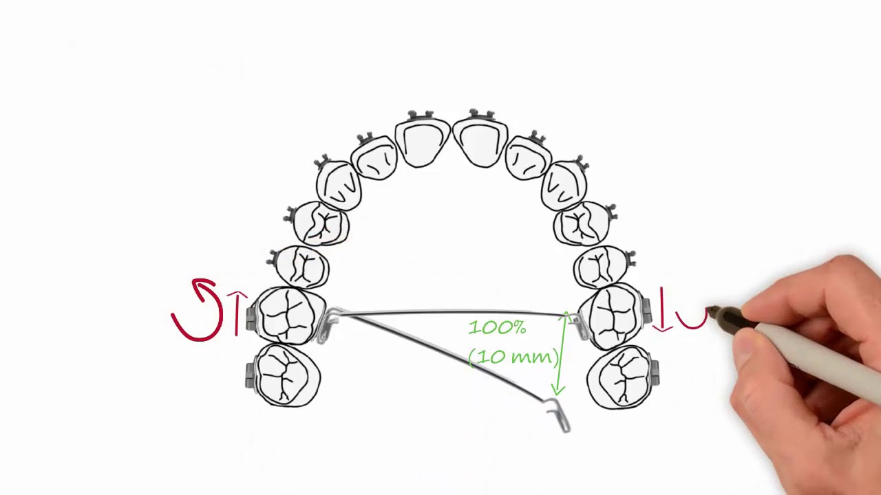 Transpalatal Arch Activations | Essential Biomechanics