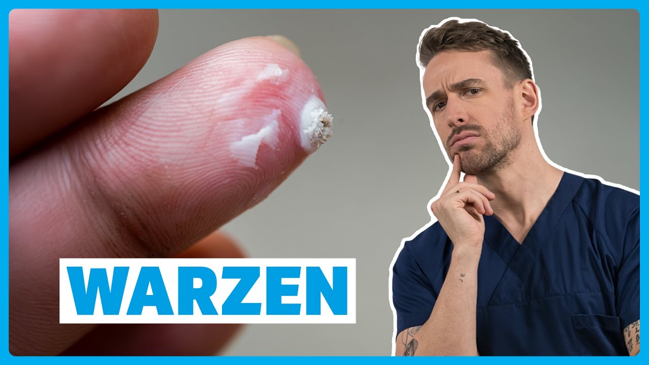 Warzen verstehen: Ursachen, Symptome, Diagnose & Therapie | DocTommy