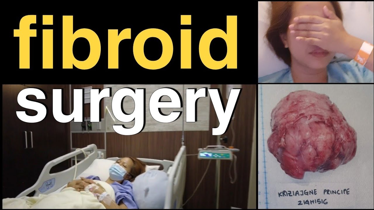 FIBROID SURGERY - ABDOMINAL MYOMECTOMY | PRE , POST OP & RECOVERY : BEHIND THE SCENES VLOG | Part 1