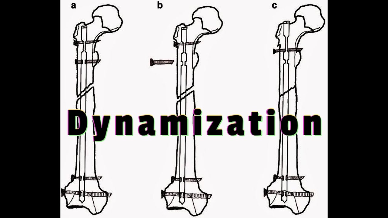 FRACTURE Dynamization -EVERYTHING YOU NEED TO KNOW