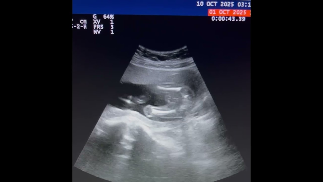 Fetal wellbeing 