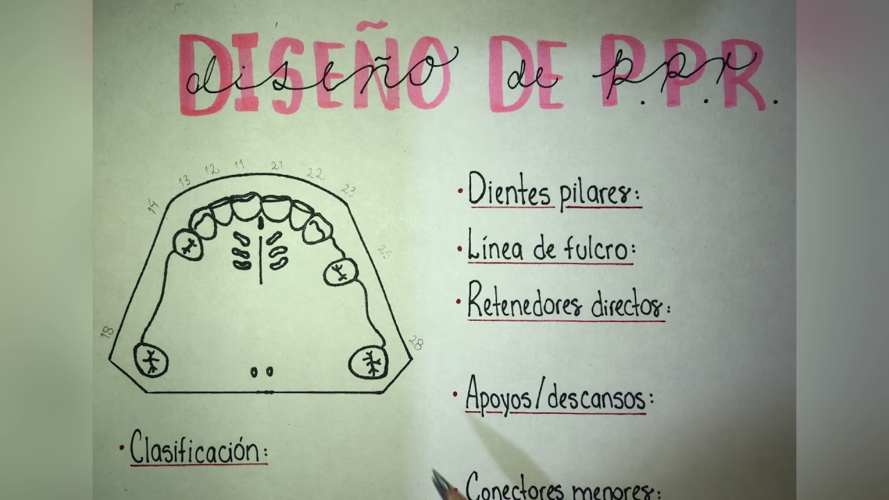 Diseño de prótesis parcial removible🦷
