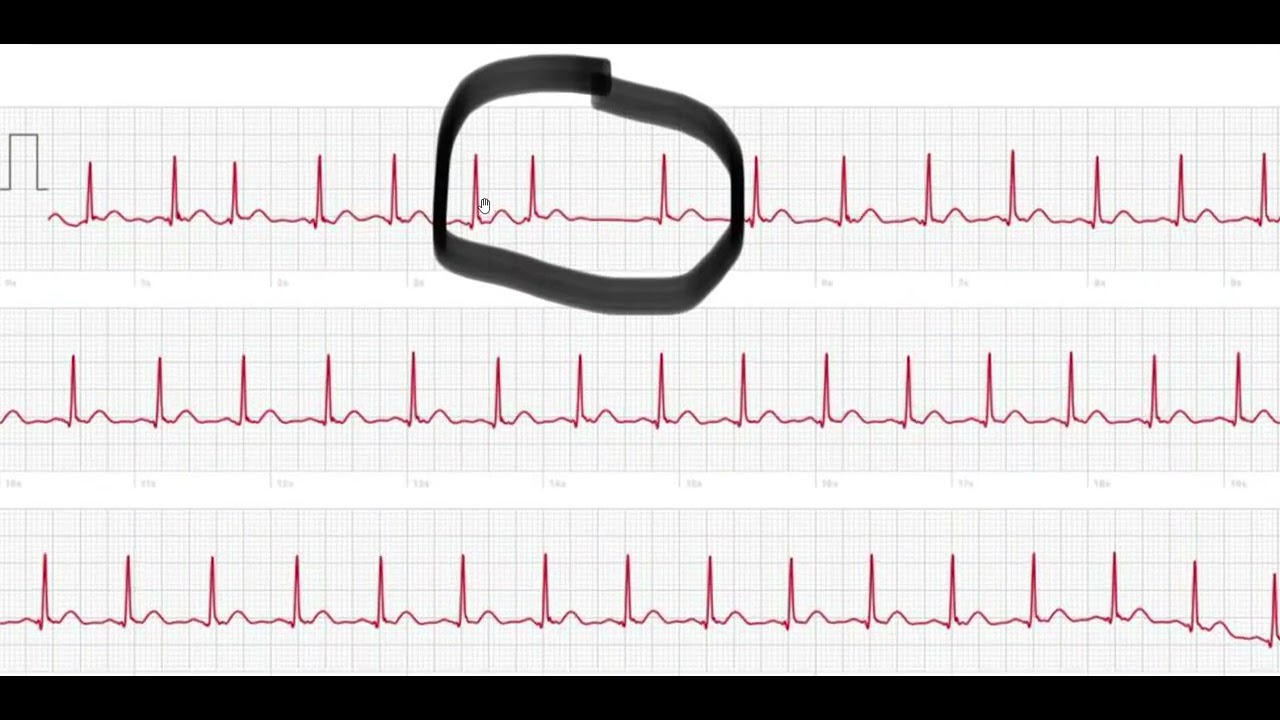 5. Podstawy EKG - przedwczesne pobudzenia nadkomorowe na zegarku Apple Watch, Kardia, Samsung.