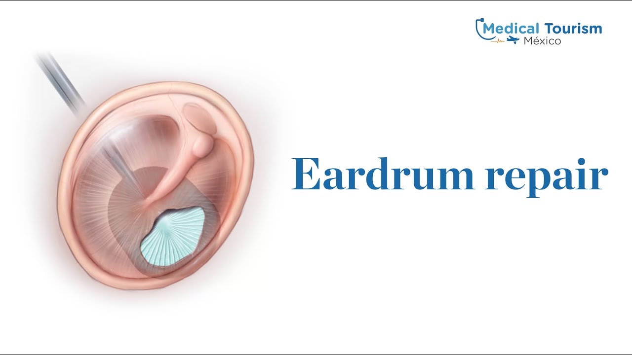 Eardrum repair - Medical Tourism Mexico