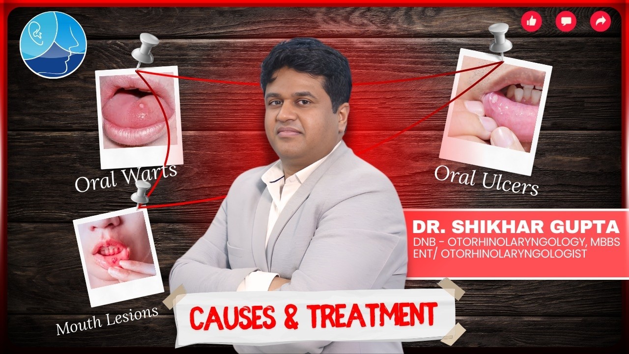 Oral Ulcers, Oral Warts & Mouth Lesions Explained | Causes & Treatment by ENT Specialist