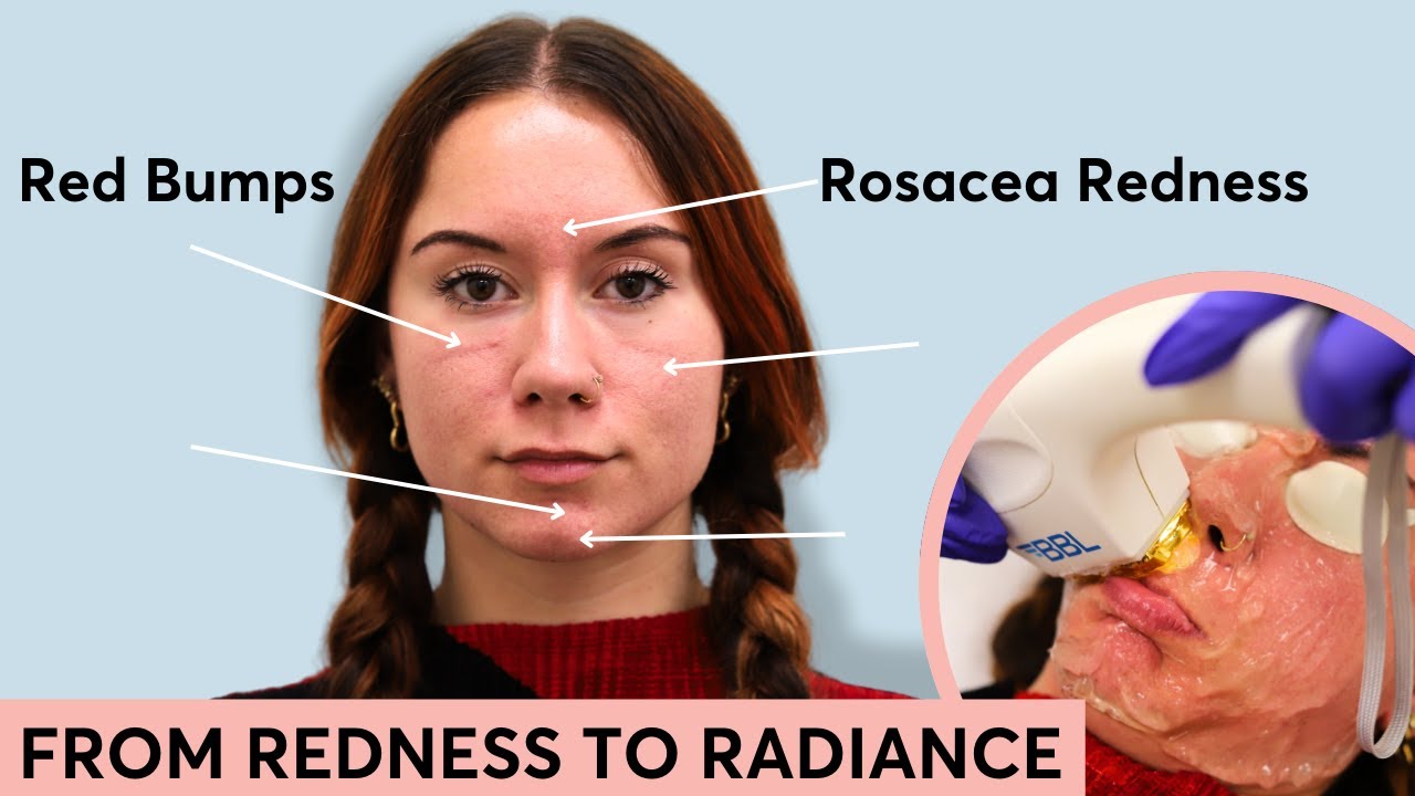 Erase Rosacea Redness with BBL Laser Therapy