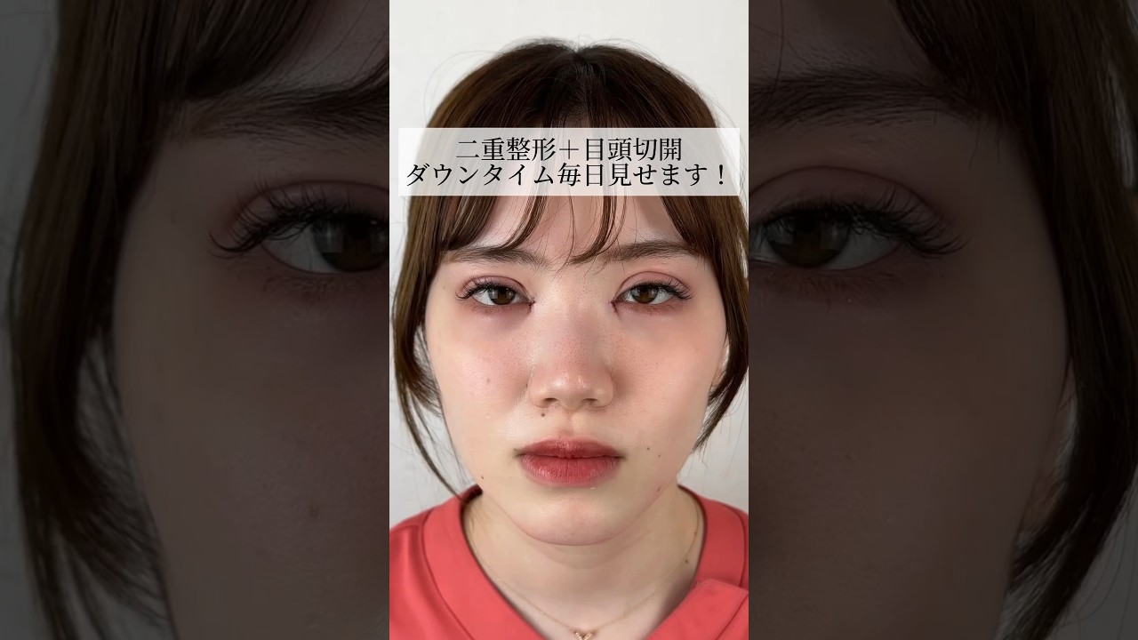 【二重整形】二重整形+目頭切開 ダウンタイム毎日見せます！ #shorts