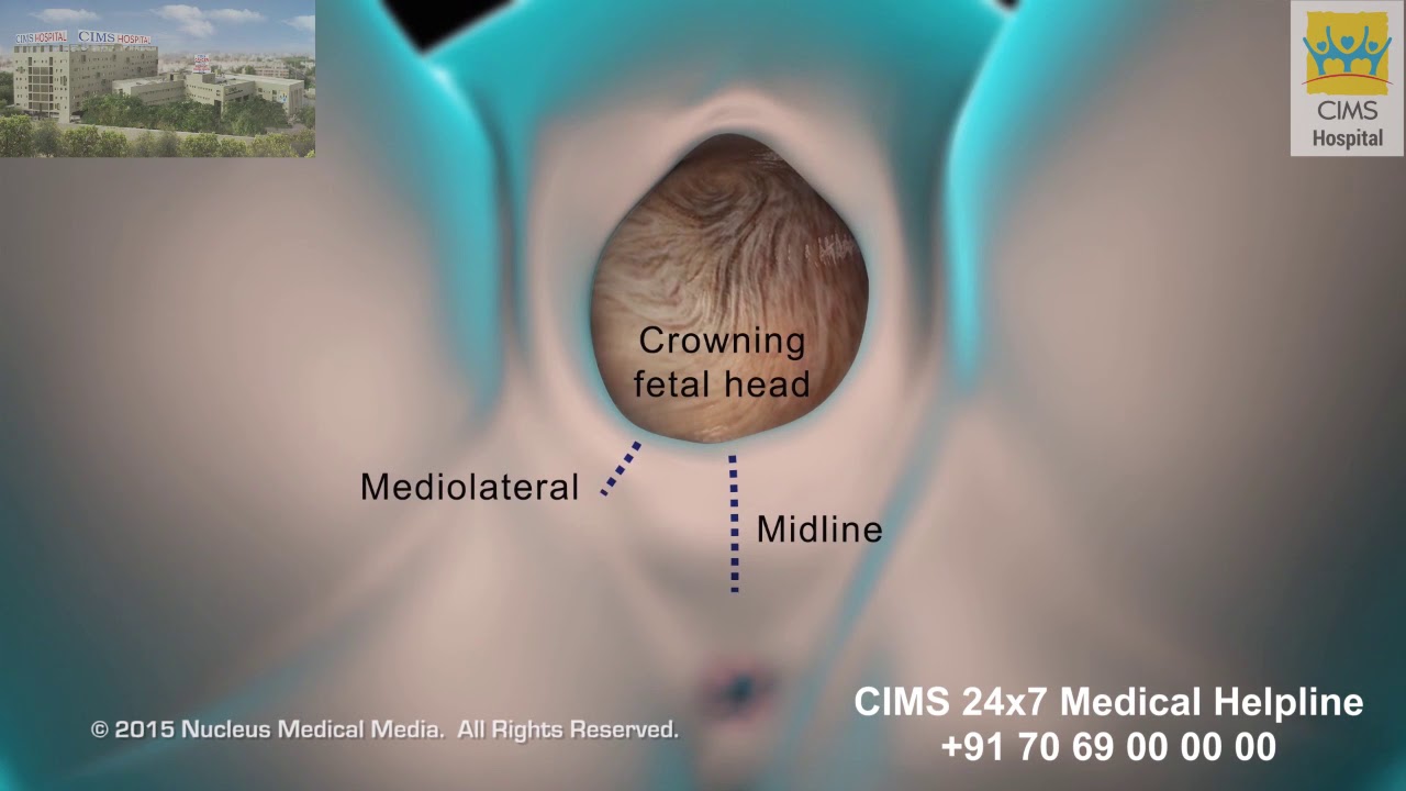 Episiotomy &ndash; CIMS Hospital