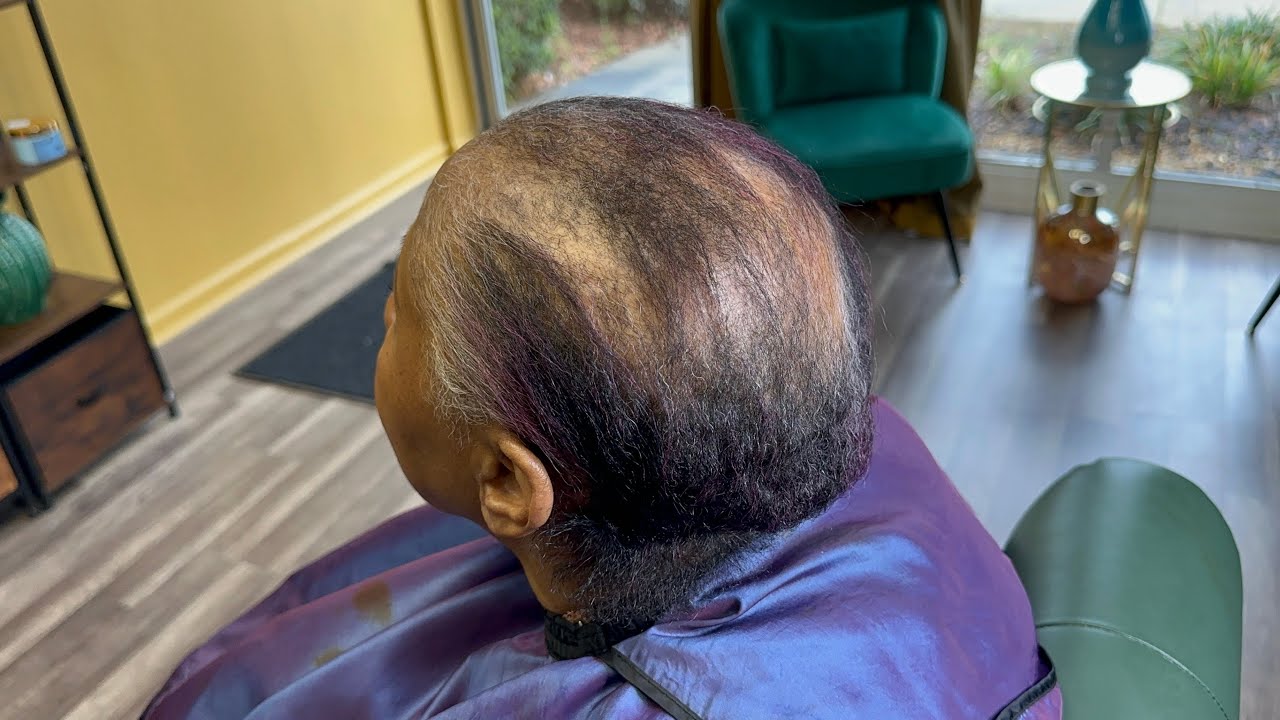 She is losing her hair and color fading into gray | Alopecia Transformation
