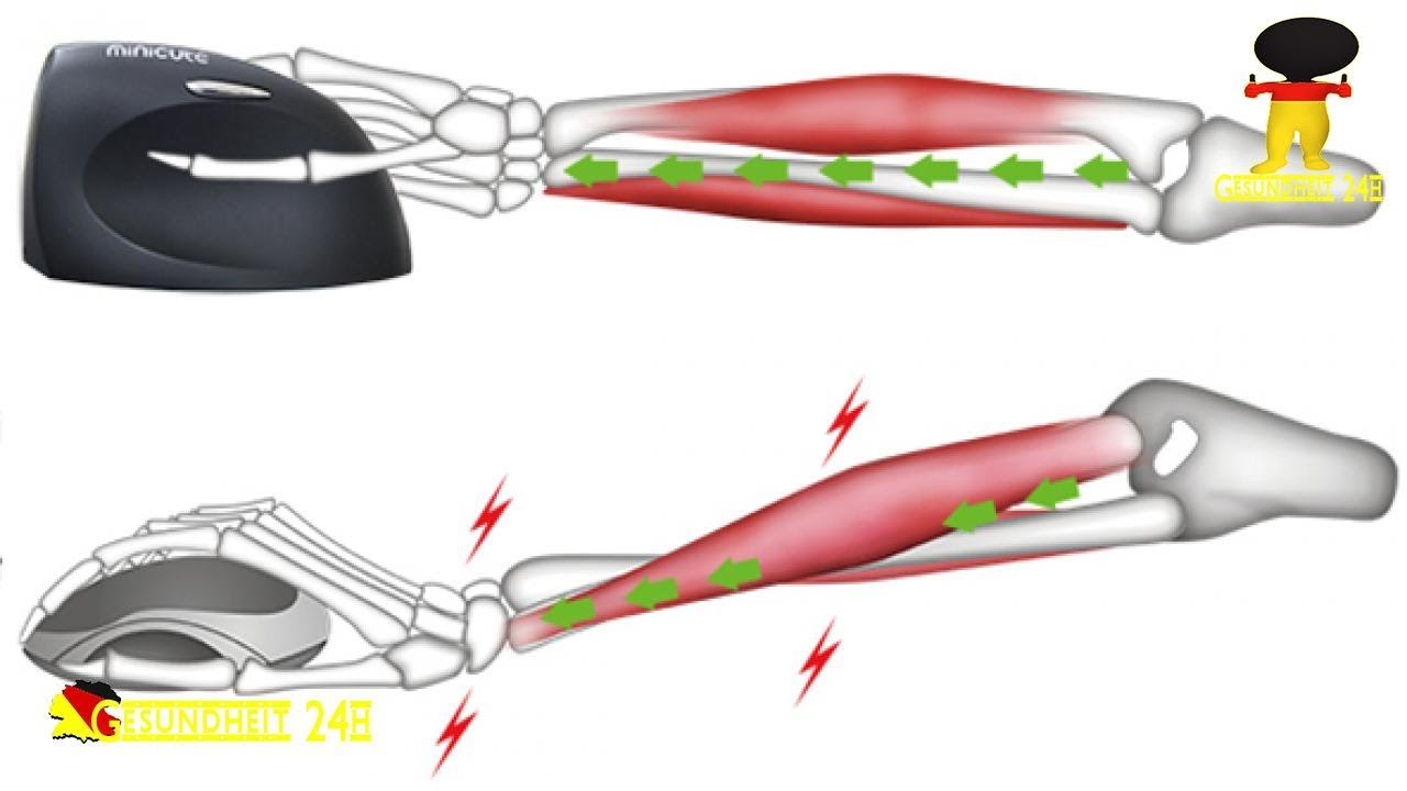 RSI-Syndrom &ndash; Mausarm durch Computer