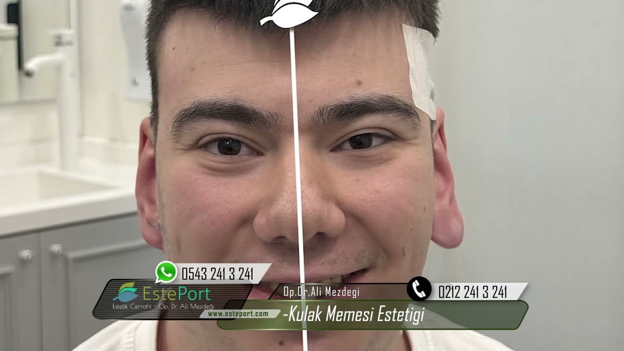 Kulak Memesi K&uuml;&ccedil;&uuml;ltme Ameliyatı | Hasta Yorumu + Sonu&ccedil;