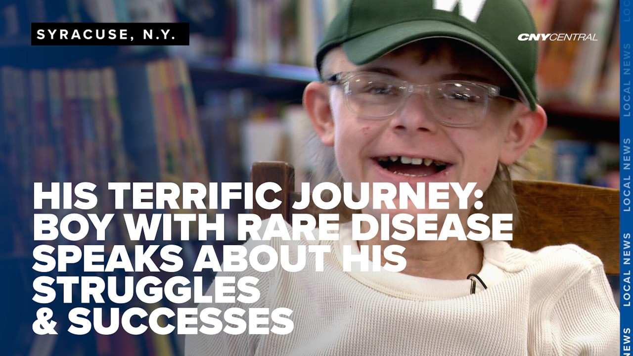 Boy with rare skin disease speaks to CNY Central for the first time