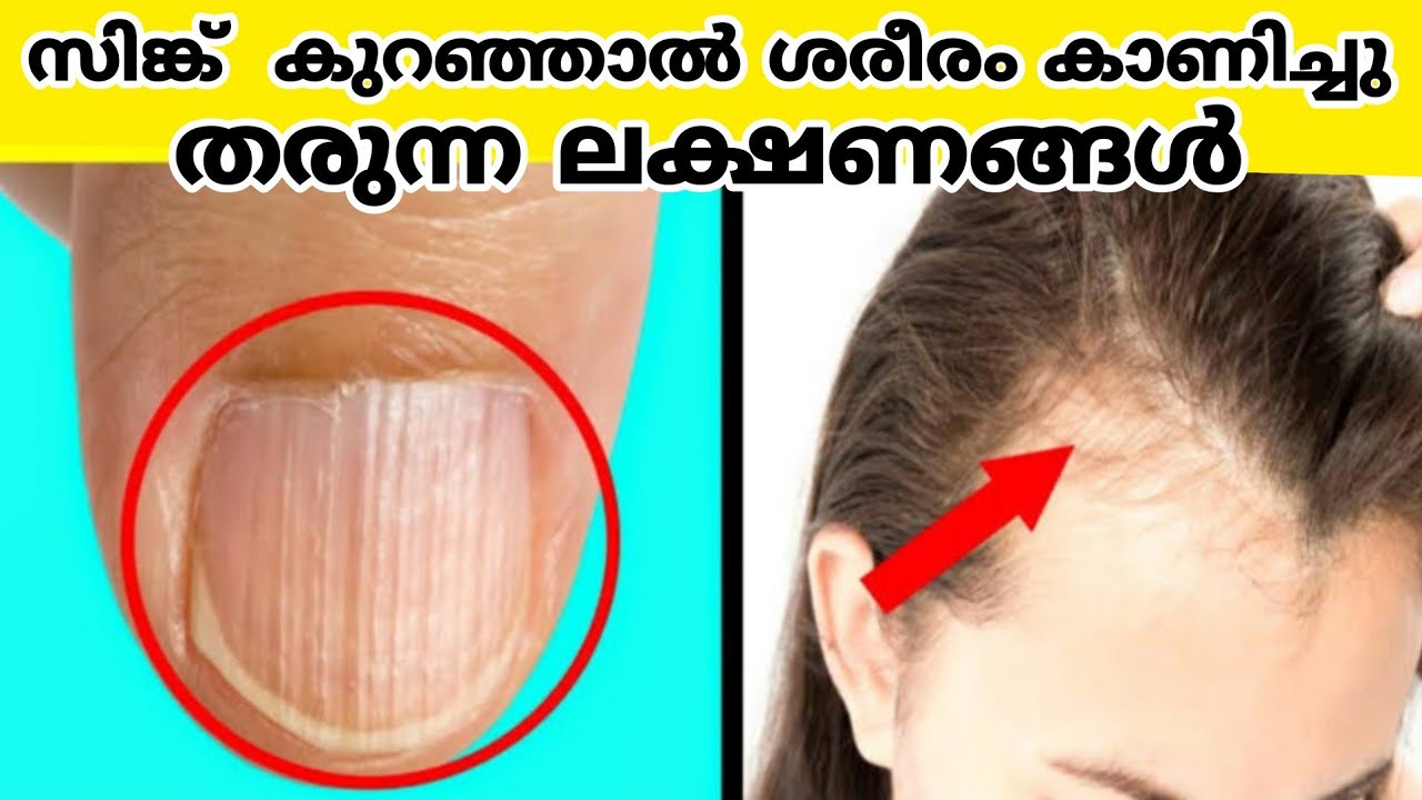 സൂക്ഷിക്കുക സിങ്ക് കുറയുന്നത് നമ്മുടെ ആരോഗ്യത്തിന് വലിയ അപകടകരം /Zinc deficiency malayalam