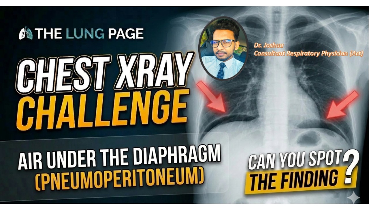 Chest X-ray Challenge - 11 - Air Under the Diaphragm