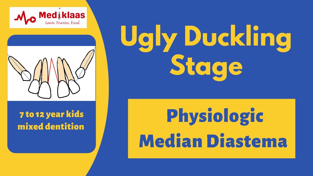 Ugly Duckling Stage l Mixed dentition l Mediklaas