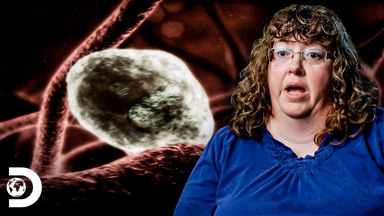Un tumor extra&ntilde;o crece dentro de una mujer | Par&aacute;sitos Asesinos | Discovery Latinoam&eacute;rica