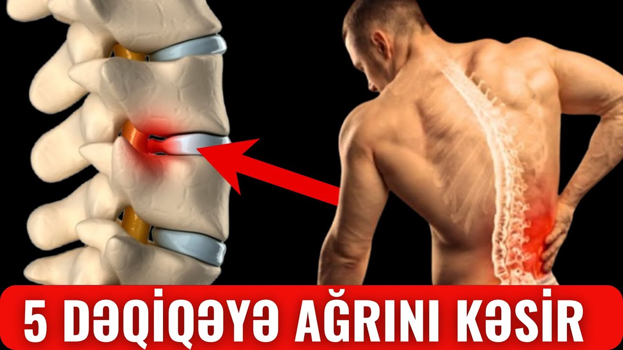 5 Dəqiqədə Sinir Ağrısına Əlvida Deyin! BEL AĞRISINA SON