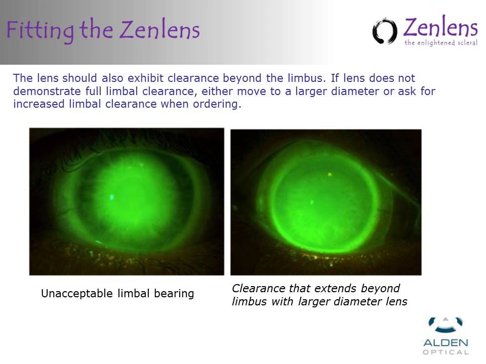 Zenlens Fitting Review