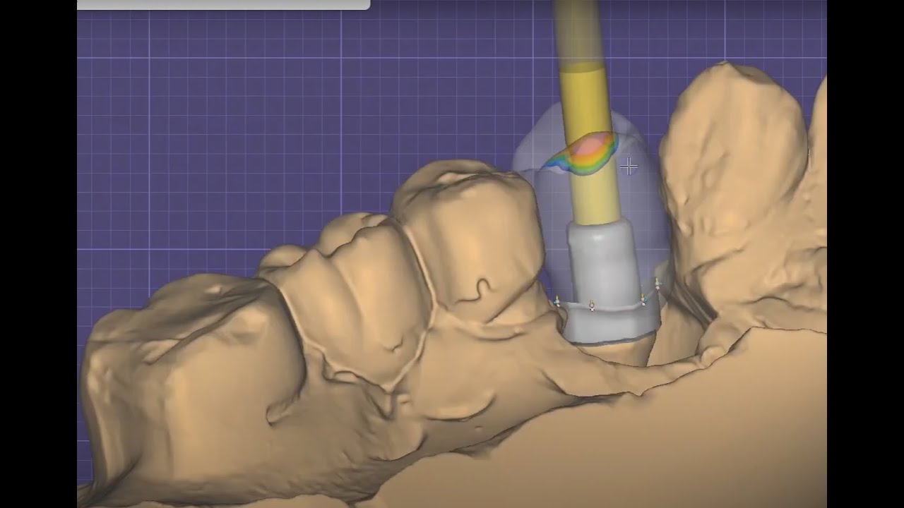 Exocad - Screw-Retained Implant Crown اكسوكاد تصميم تاج زيركون على زرعة .