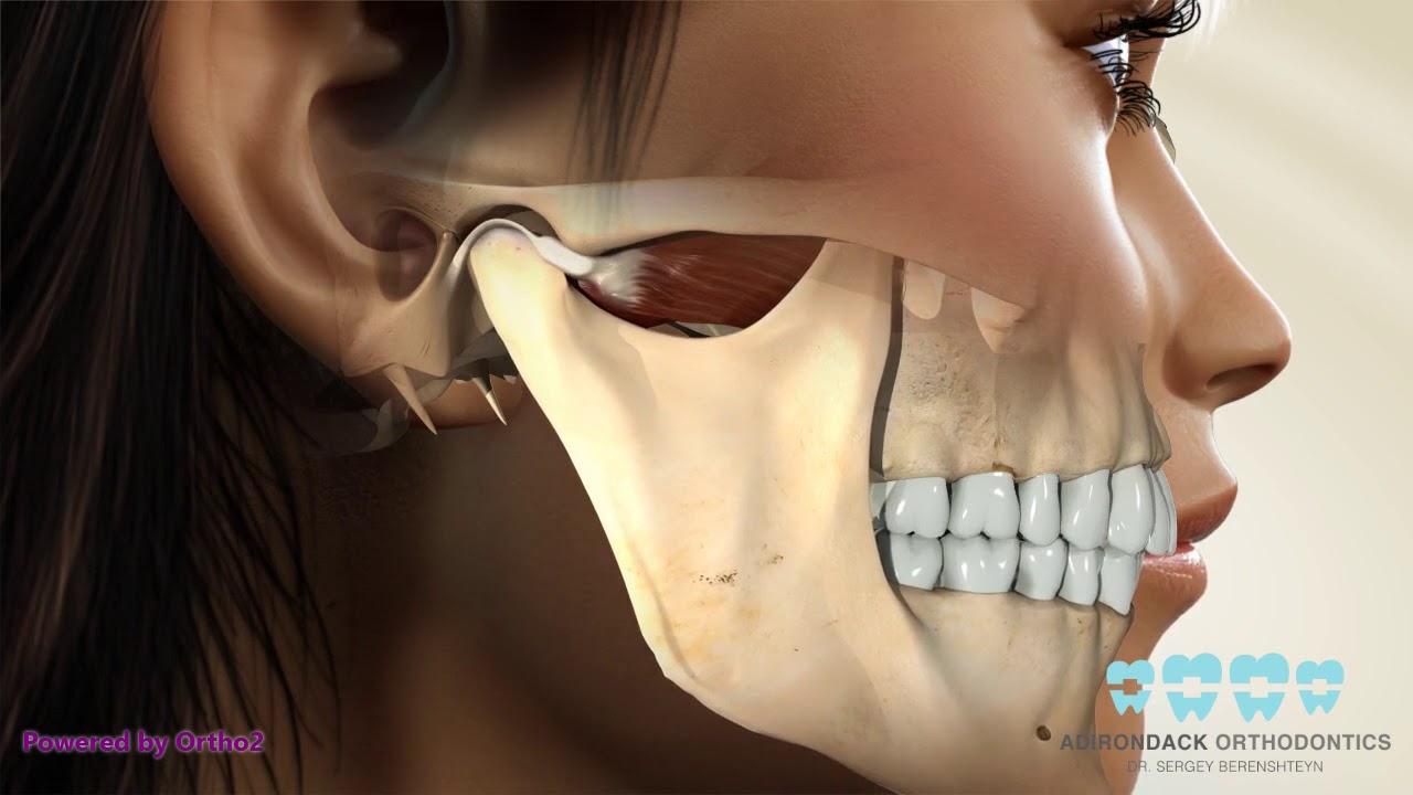 TMJ splint