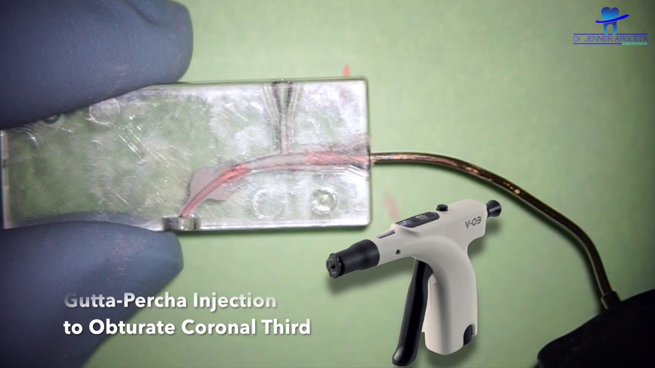 Sandwich technique for repairing root canal perforations (EQ-V - MAP-System)