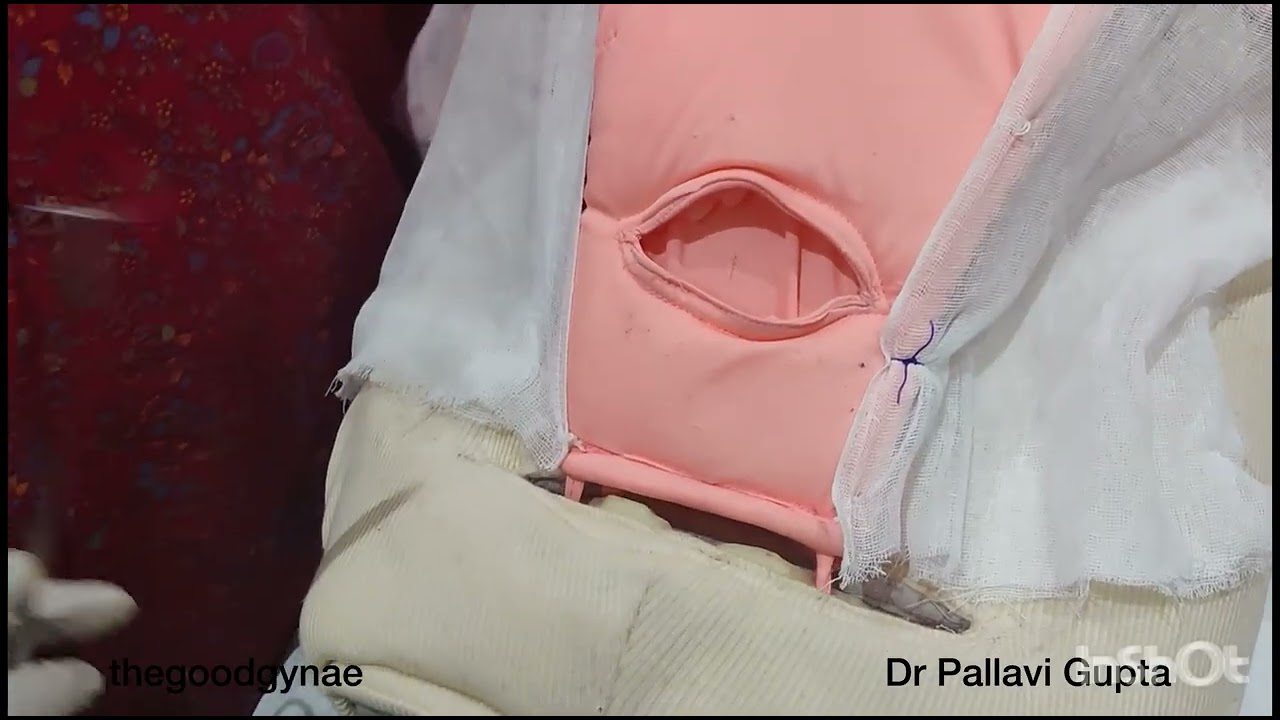 PPH: STEPWISE DEVASCULARIZATION | UTERINE VESSEL LIGATION | UTERO-OVARIAN ANASTOMOSIS LIGATION