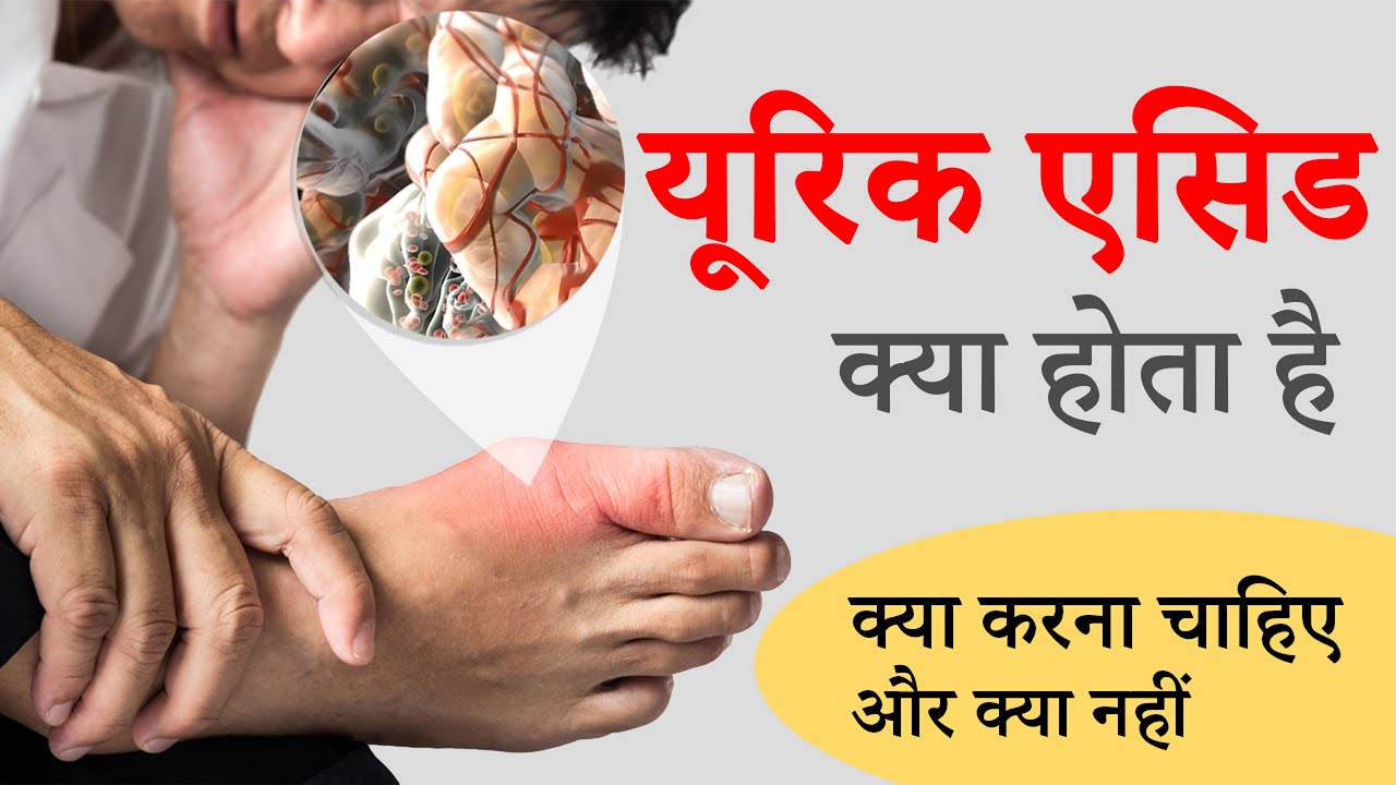 Uric Acid Kya Hota Hai? Uric Acid - Food, Symptoms, Excercise & Treatment | Uric Acid Home Treatment