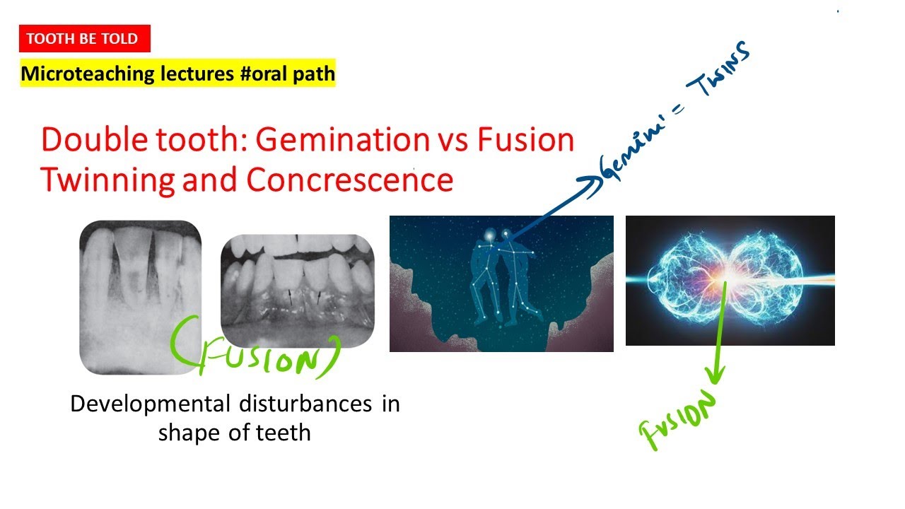 Gemination vs Fusion | Twinning | Concrescence | The only video you need to watch | ORAL PATHOLOGY