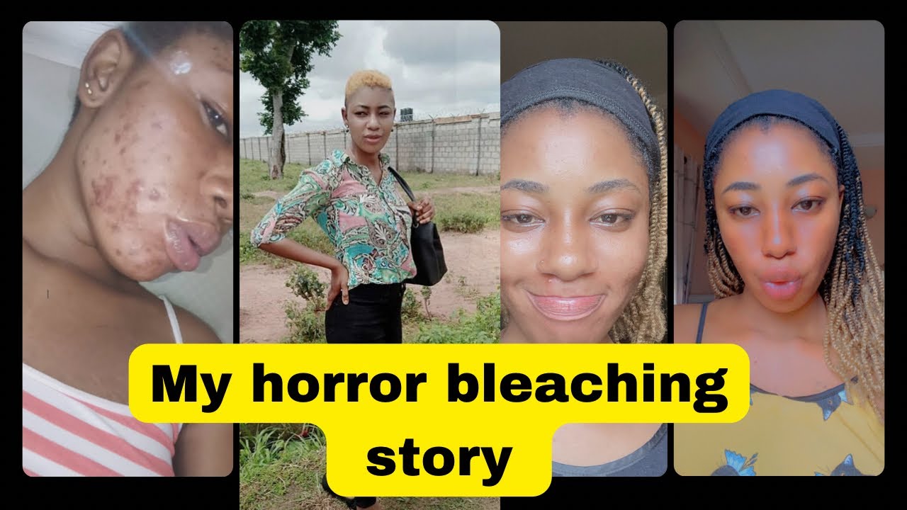 I Can't Stop Bleaching My Skin Please Help 😭 #skincare #skinbleaching