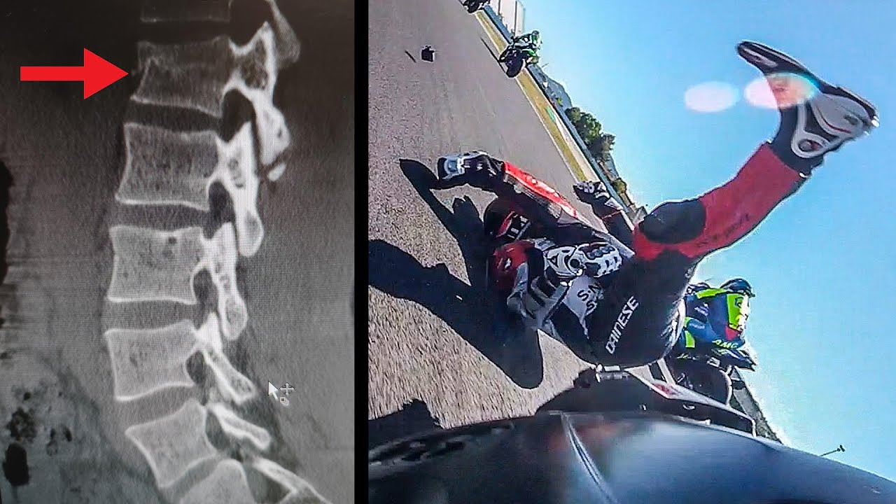 COME HO FATTO A CADERE? TORNERÒ A CORRERE? - Analizzo l'incidente di Misano e racconto il ricovero