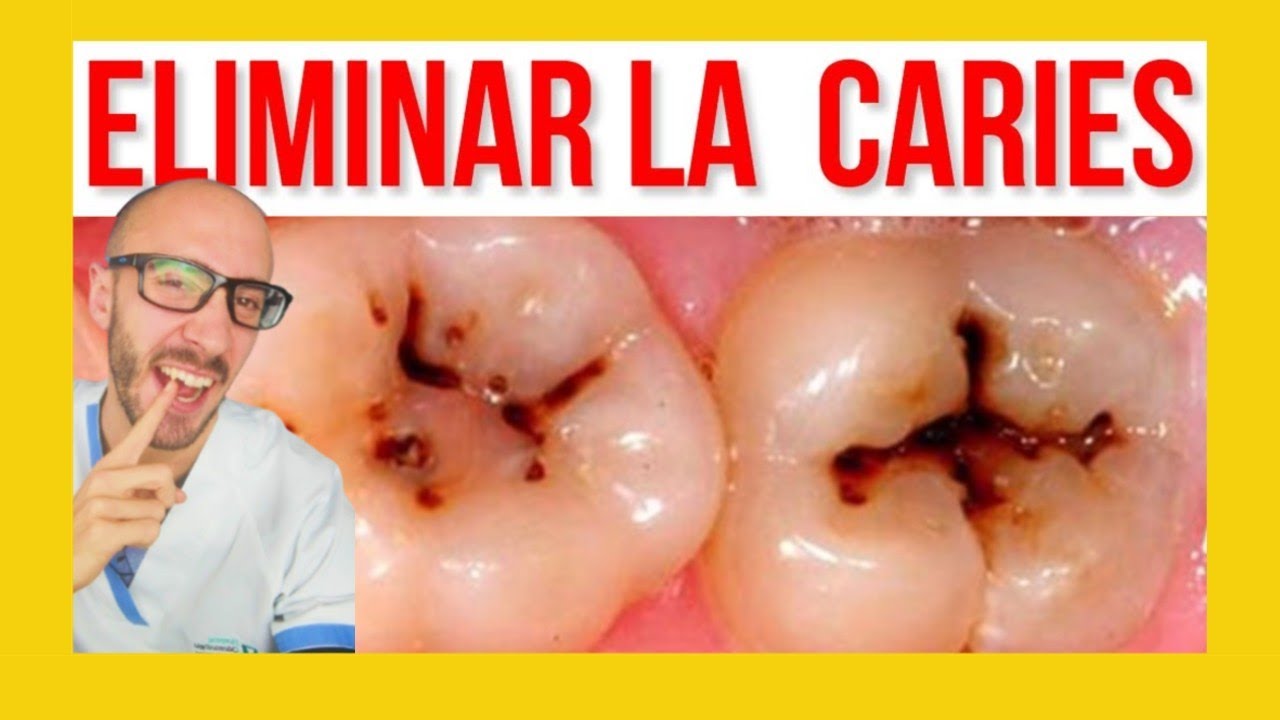 ⚠️Como se hace un EMPASTE DENTAL ✅ Reconstrucci&oacute;n clase I y II