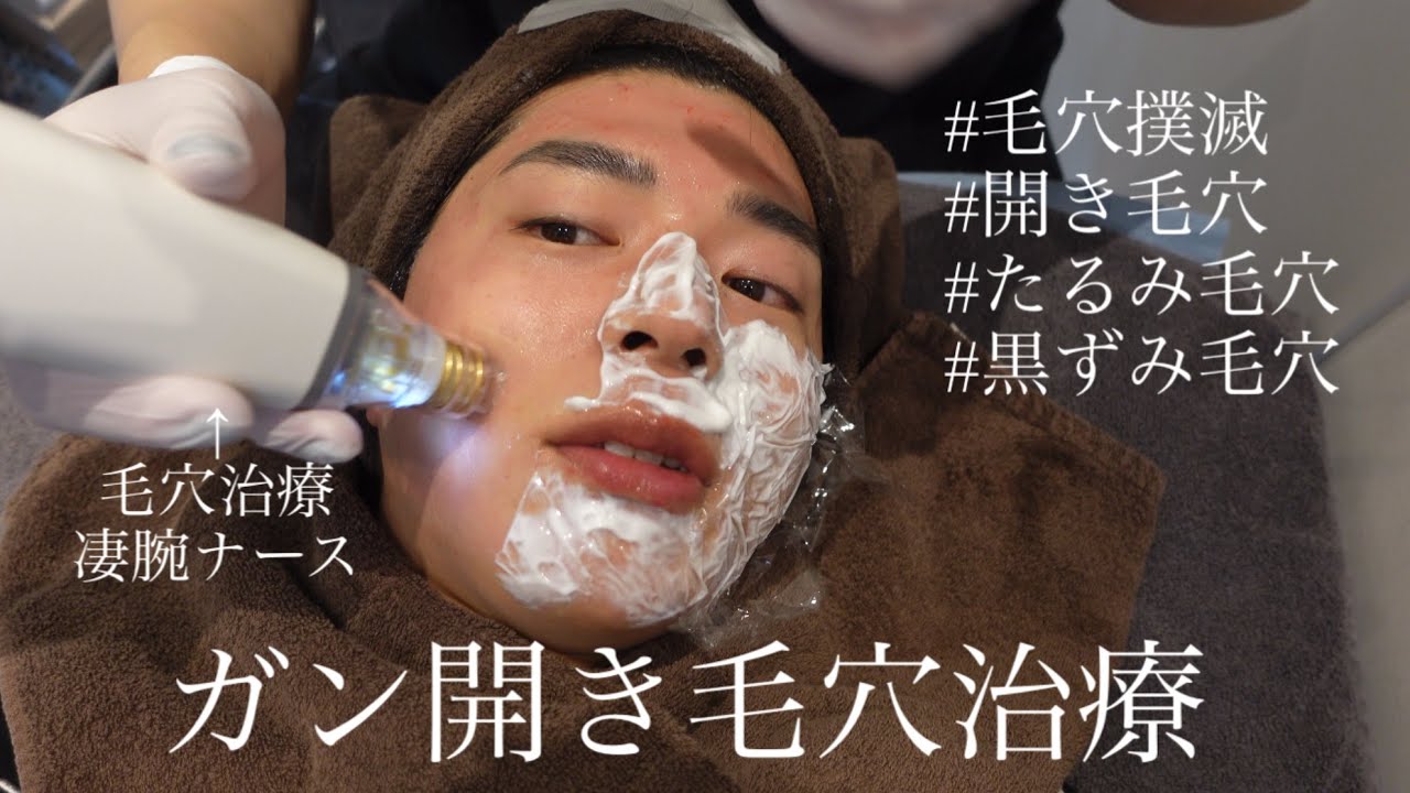 毛穴晒して治療してます。