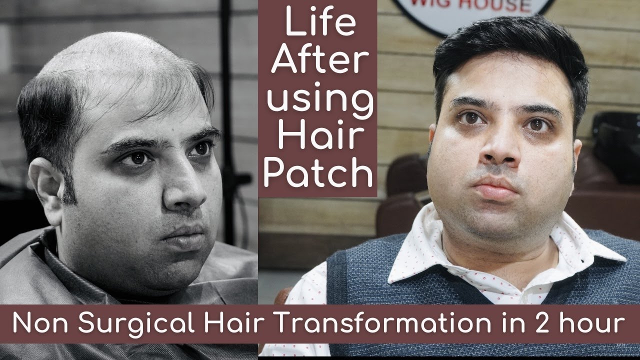 Hair Patch For men | Best Non Surgical Hair patch System | Hair Replacement in 2 hour | 9953384242