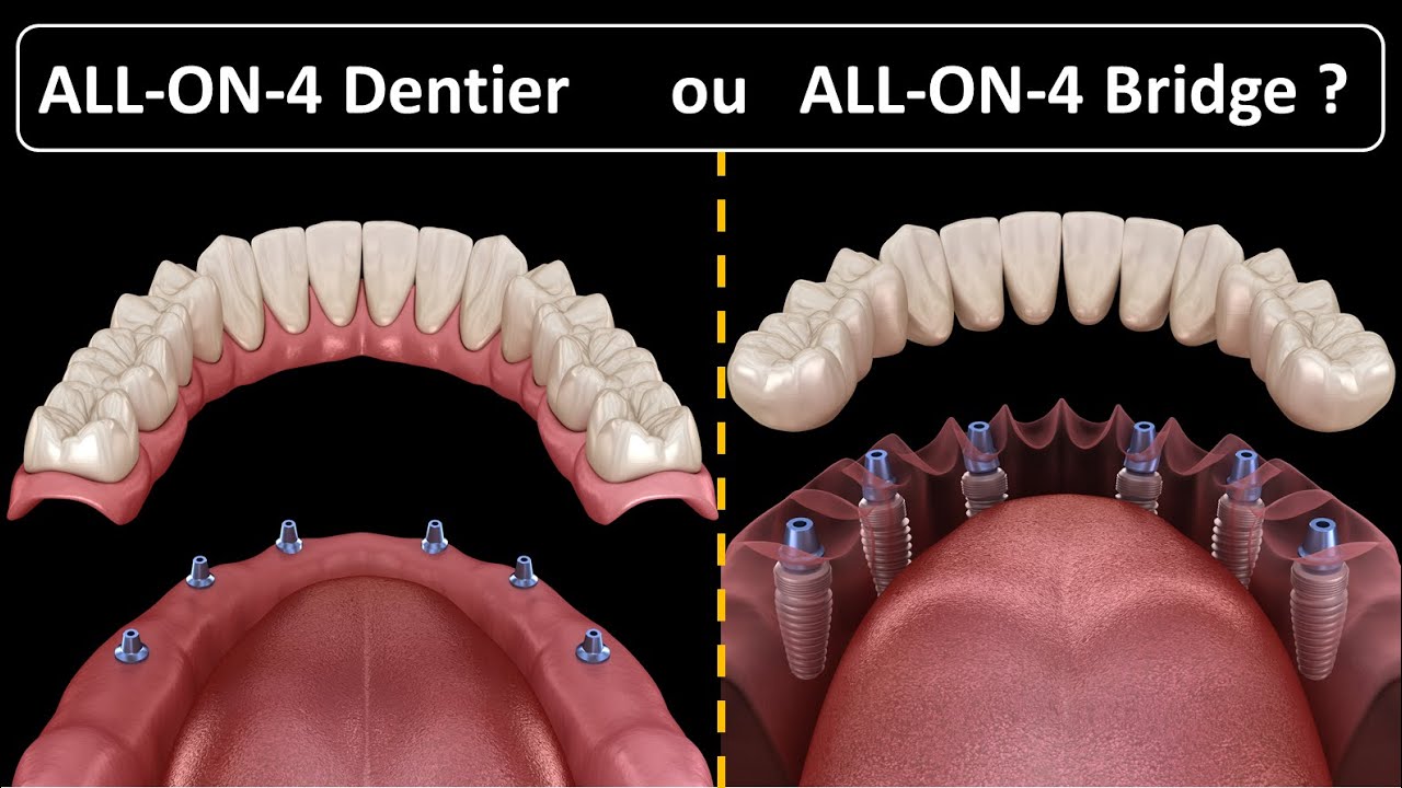 All on 4 - Type de prothèse :  Dentier ou Bridge ?