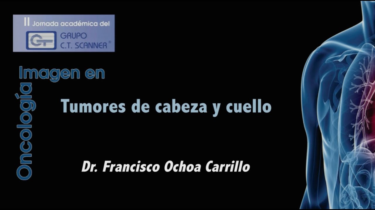 Tumores de cabeza y cuello