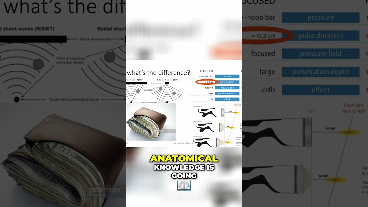 From Focused to Radial: Shockwave Therapy Comparison and Benefits