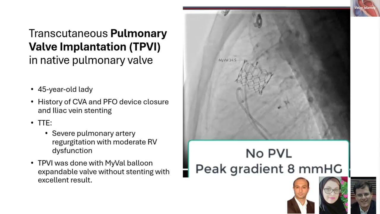 Transcutaneous Pulmonary Valve Implantation (TPVI) in native pulmonary valve