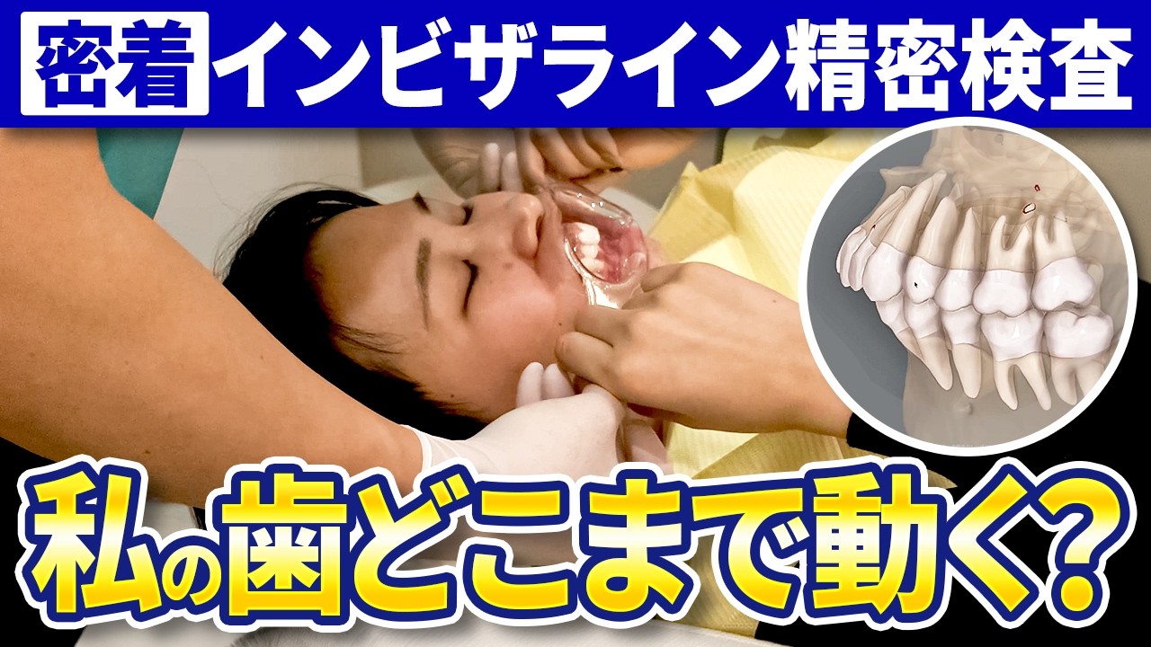 【密着シリーズPart2】インビザラインで重要な資料取りとクリンチェックについて