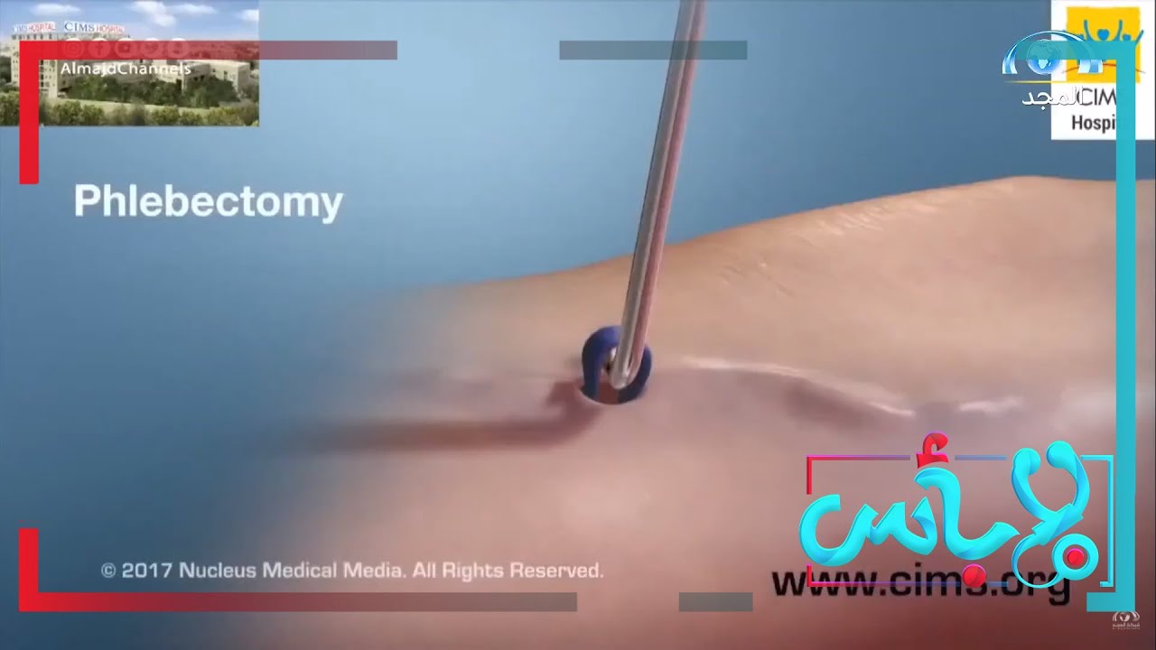 ما الفرق بين العلاج الجراحي المفتوح والعلاج الجراحي بالمنظار في علاج دوالي الساقين؟|د.عبدالعزيز أحمد