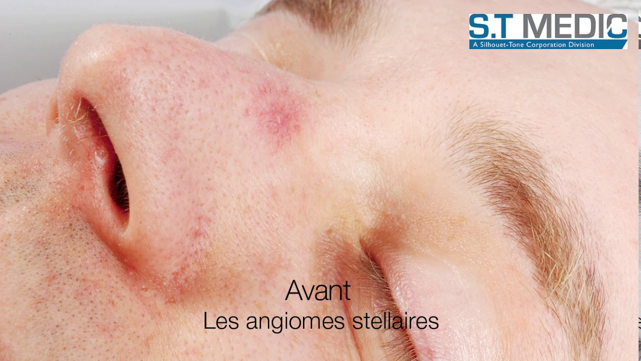 Système de thermocoagulation - Avant / après