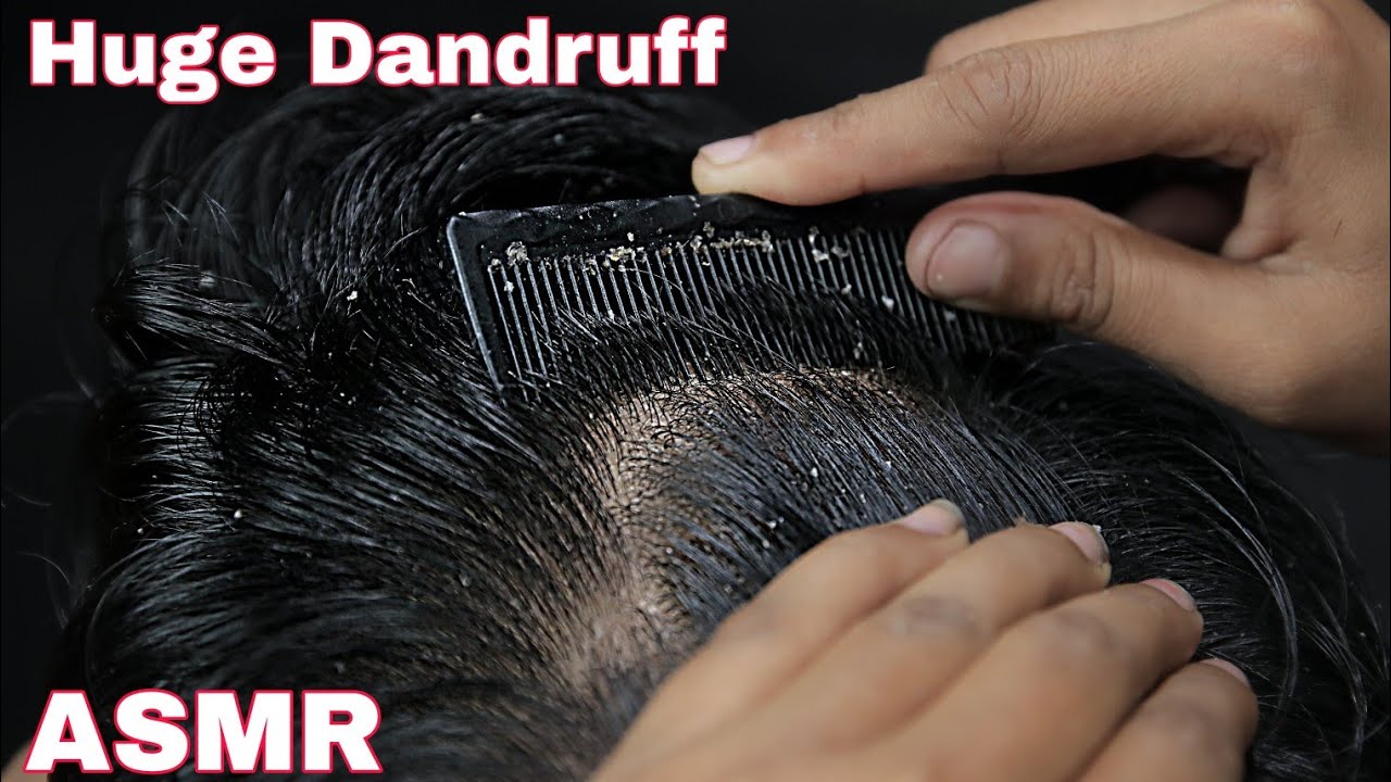 ASMR Dandruff Removal | Satisfying Dandruff Removal | Dandruff Scratching ASMR