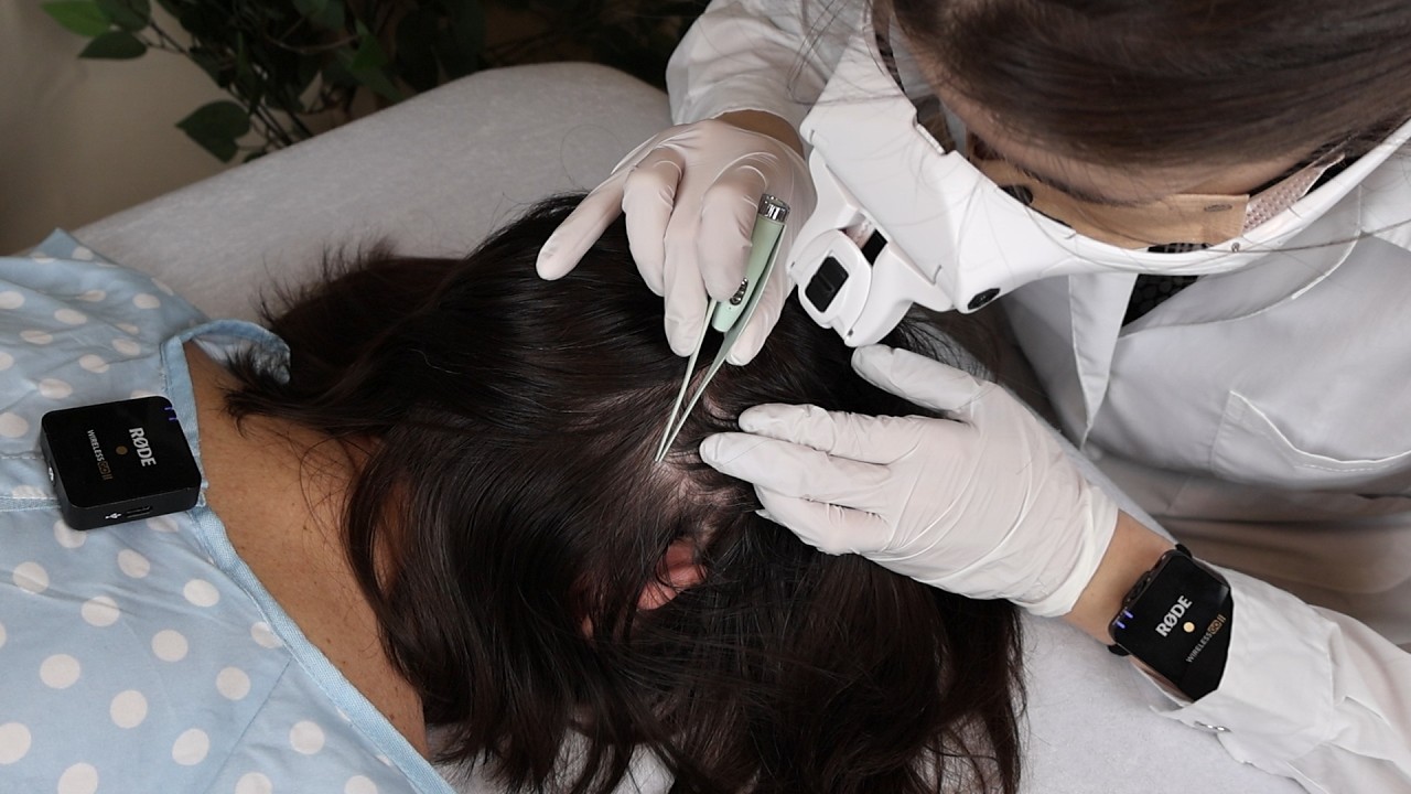 ASMR Detailed LICE Removal from Scalp & Behind EAR with Tweezers