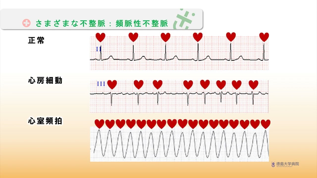 徳島大学病院「TVいきいきらいふ」第192回 不整脈から命を守る① －不整脈の徴候・症状と検脈の仕方－