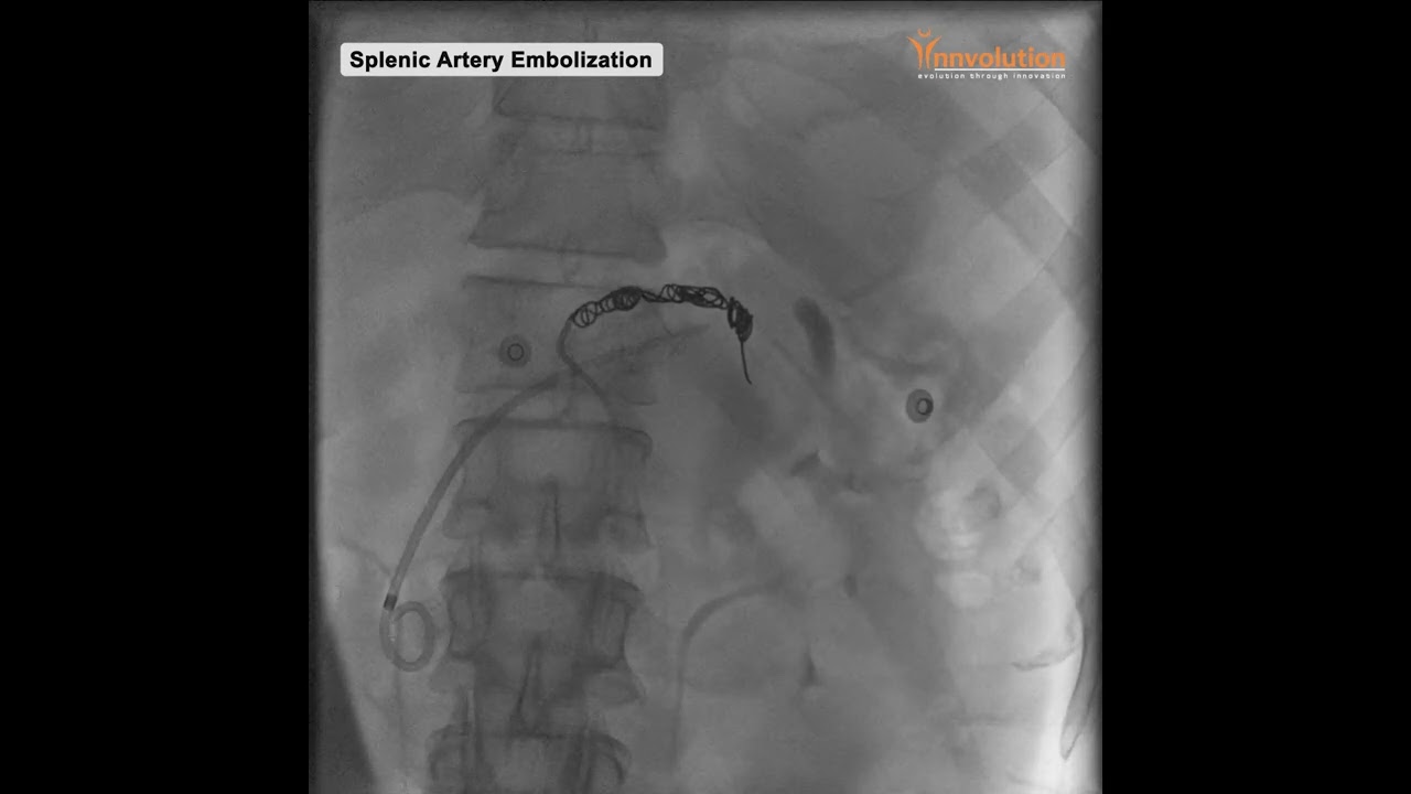 Splenic Artery Embolization performed on Premier Elite