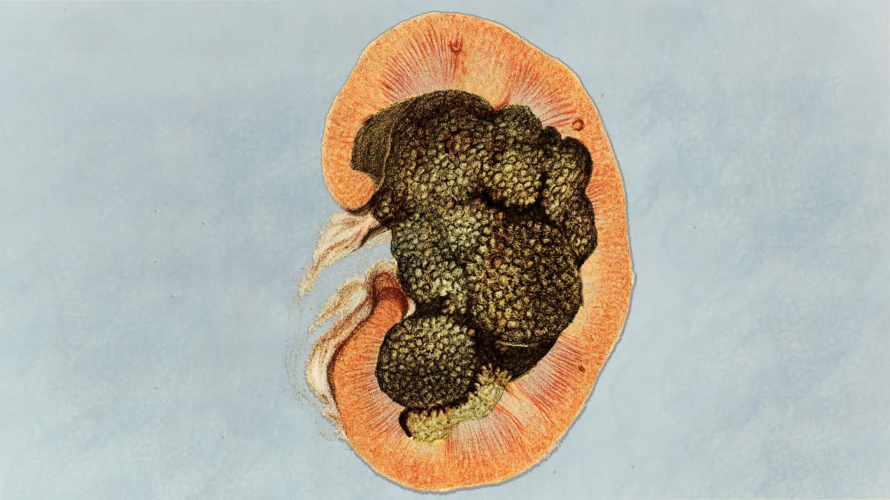 Un Atleta Hizo 500 Sentadillas En 20 Minutos. Esto Le Ocurrió A Sus Riñones.