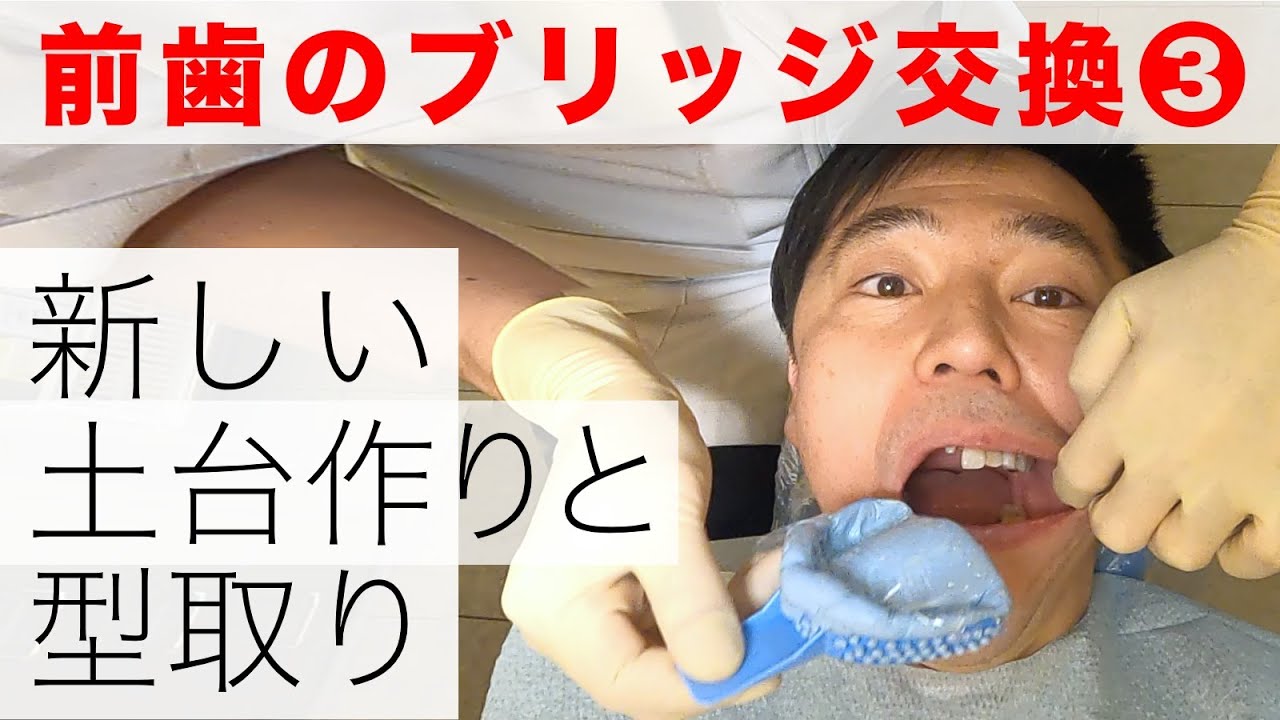 前歯のブリッジ交換③歯抜けはつらいよ｜差し歯を支える土台の作成と型取り【歯列矯正後の治療】
