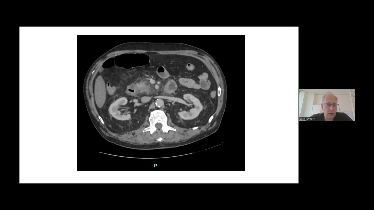 “What’s new in pancreatic cystic lesions ” - Dr Sean Burmeister
