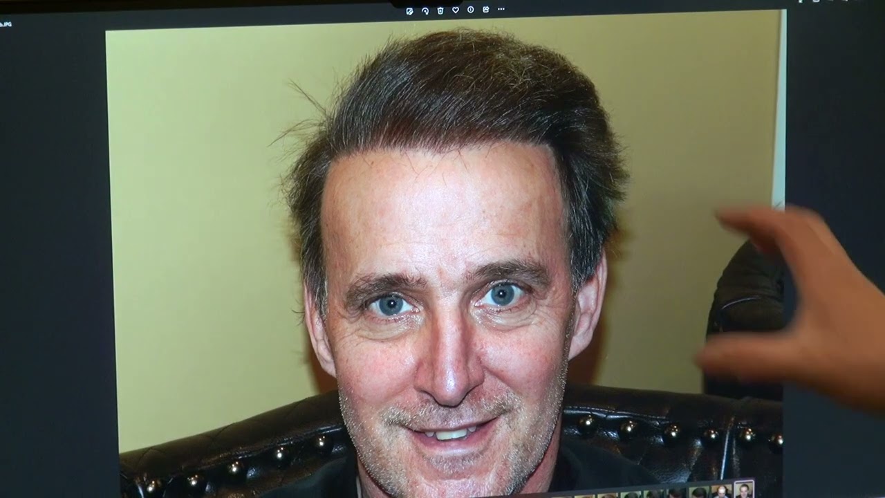 Caucasian Male Patient with Advanced Hair Loss | MHTA Clinic