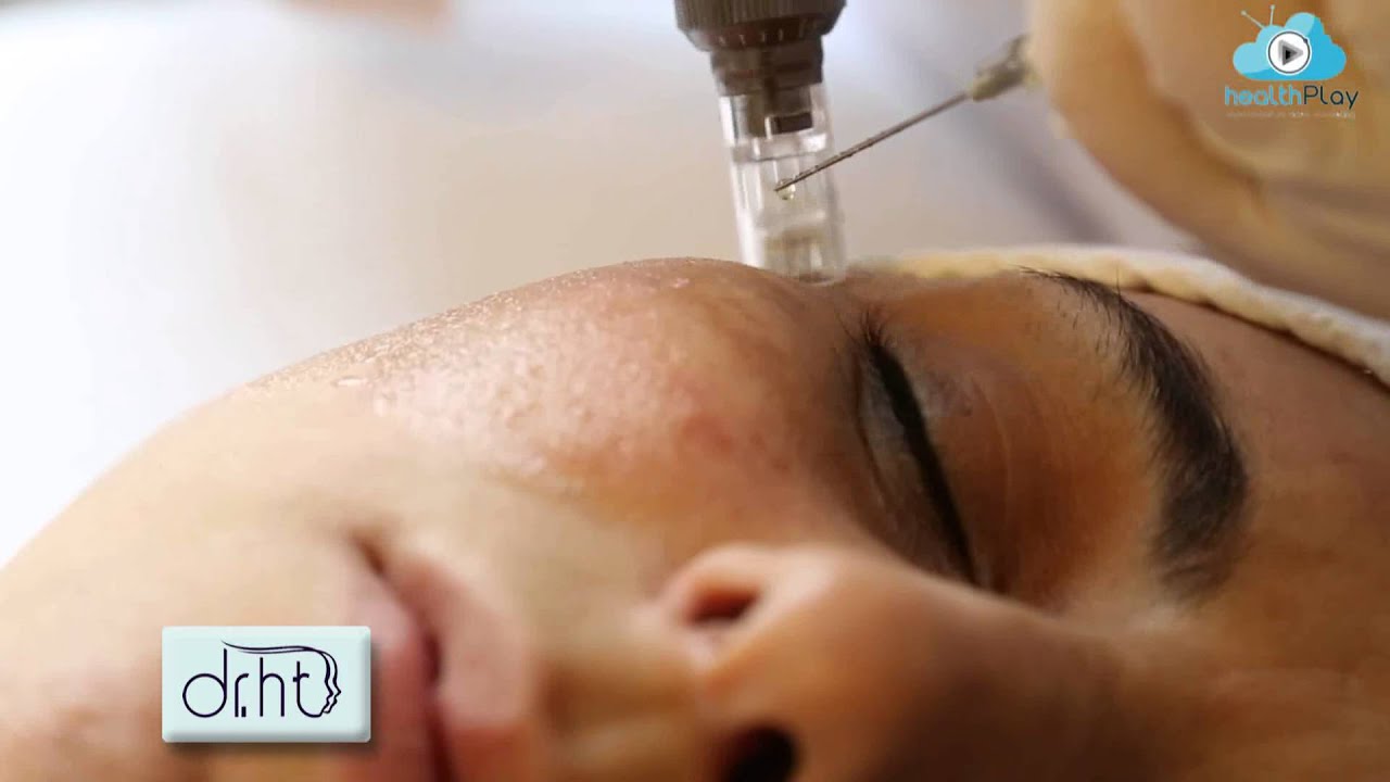 Dermapen uygulaması nedir? - Dr. Hüseyin Tırman